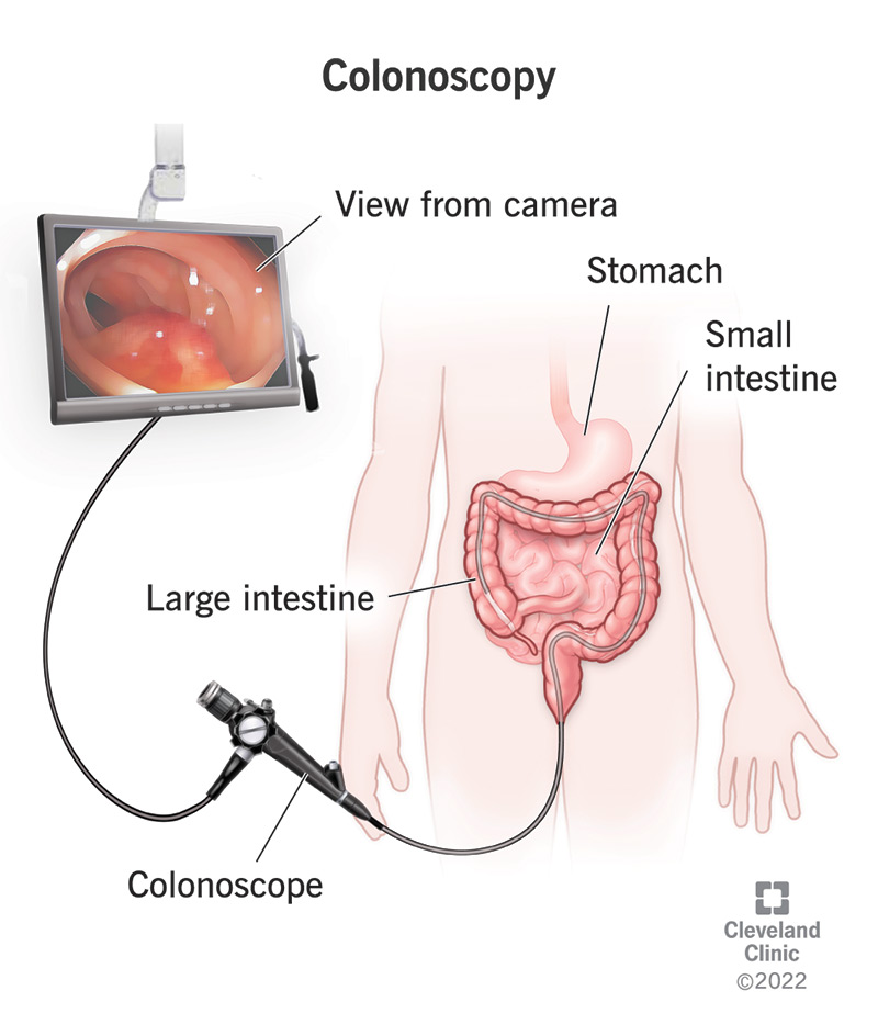 Colonoscopy
